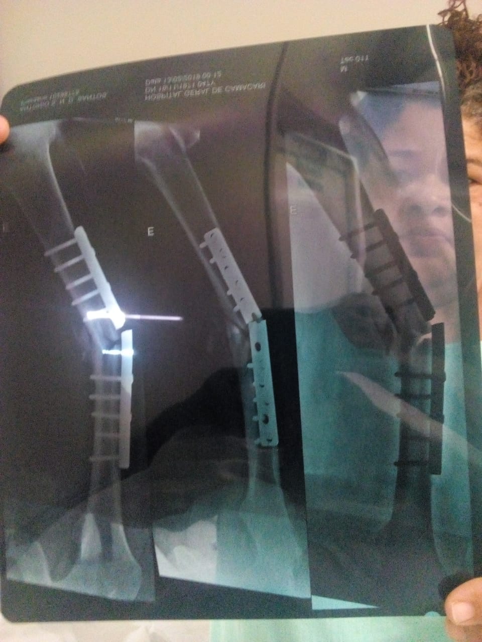 Sidney teve a placa rompida em sua perna dois meses depois de implantada - Foto cedida